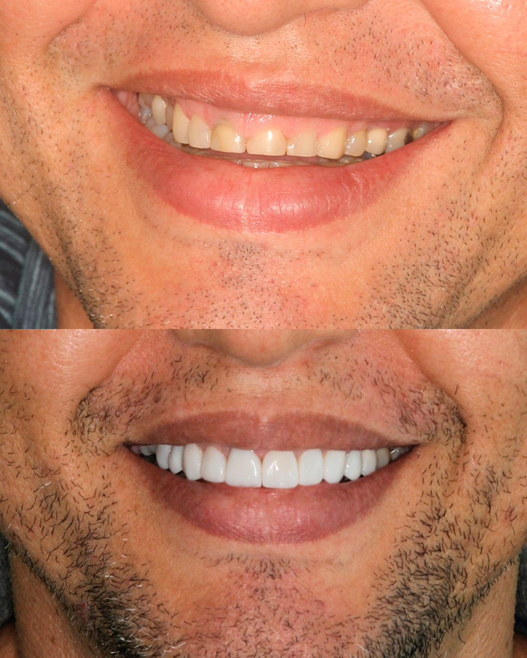 Implantes e Próteses